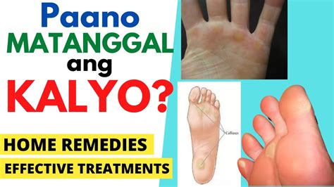 ano ang gamot sa kalyo sa paa